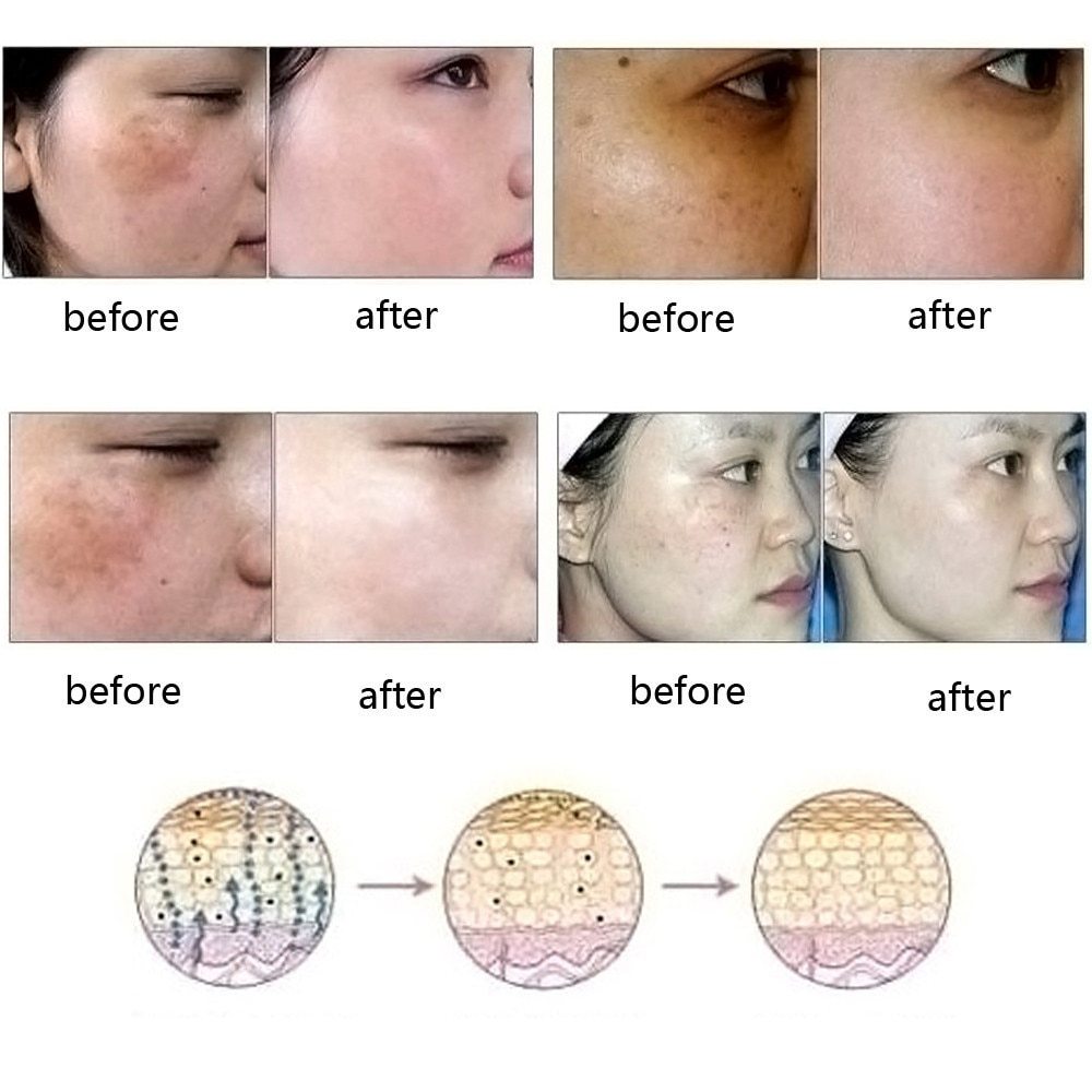 Dredge Meridian Skin Care Natural Pure Removal Acne Stretch Marks Scar Removal Essence oil Dredge Meridian Skin Care Natural Pure Removal Acne Stretch Marks Scar Removal Essence oil